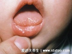 早期婴儿鹅口疮的图片和症状，感染轻微