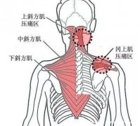 背部筋膜炎疼痛位置图，身体背部各部位疼痛对比图。
