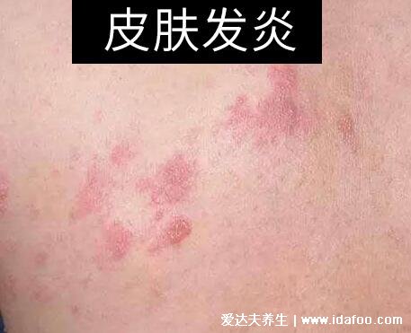 床上螨虫咬的症状图片，似蚊子包夜晚比白天瘙痒(螨虫最怕这3种东西)