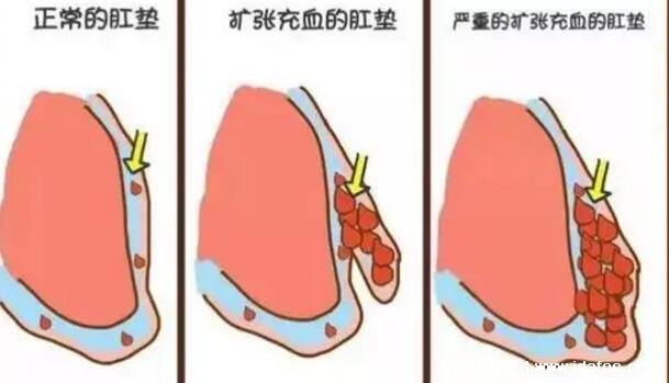 痔疮长什么样子的图片，真实的轻微痔疮图片大全