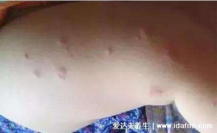 床上螨虫咬的症状图片，似蚊子包夜晚比白天瘙痒(螨虫最怕这3种东西)