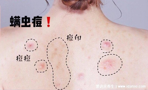 床上螨虫咬的症状图片，似蚊子包夜晚比白天瘙痒(螨虫最怕这3种东西)