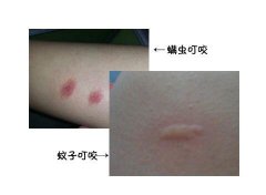 床螨叮咬的症状图片，像晚上比白天痒的蚊子(螨虫最怕这三样东西)