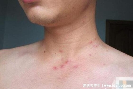 女人艾滋病的三大症状图片，对比艾滋病初期小红点照片自查