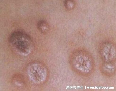 尖锐湿尤图症状图片男性症状，隐私部位现菜花状疣体(潜伏期多在3个月)