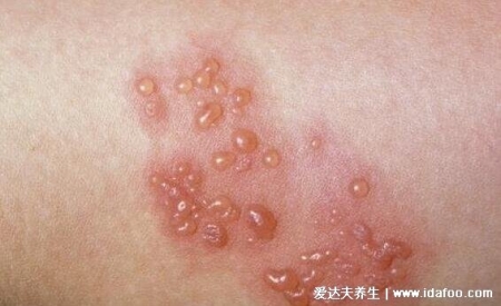 皮肤病图片对照大全查看图片，包含100种疾病的症状图自测