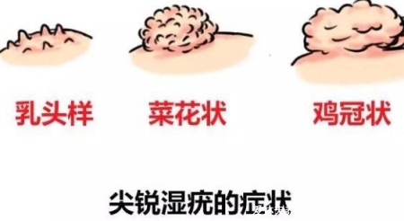 尖锐湿尤图症状图片男性症状，隐私部位现菜花状疣体(潜伏期多在3个月)