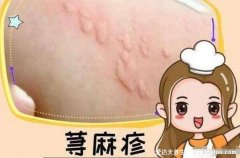 风疹块止痒小妙招，荨麻疹最怕四个土方
