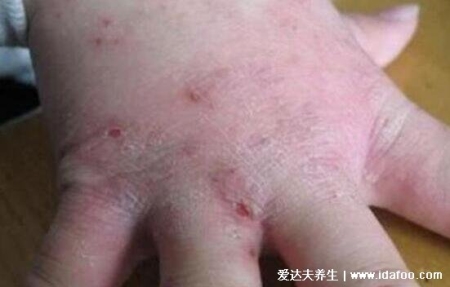 皮肤病图片对照大全查看图片，包含100种疾病的症状图自测