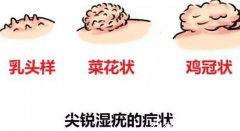尖锐湿尤图症状图片男性症状，隐私部位