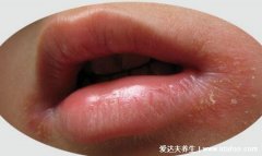嘴角长疱疹口腔溃疡(口唇疱疹和口角炎的