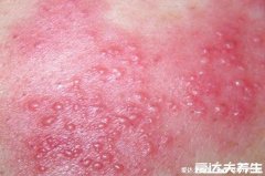 100种皮肤病对照表，警惕常见皮肤病类型
