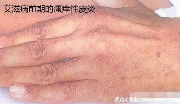 一个月不发烧基本排除艾滋病，不准确潜伏期可达15年(信任检测结果)