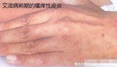 艾滋病有潜伏期吗能检测么(艾滋病无症状