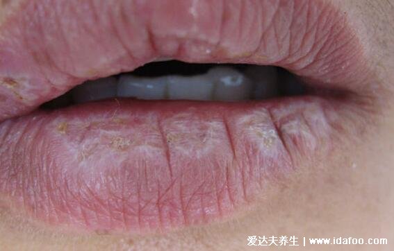 扁平苔藓图片症状，口腔长白斑/皮肤上有紫红色扁平丘疹