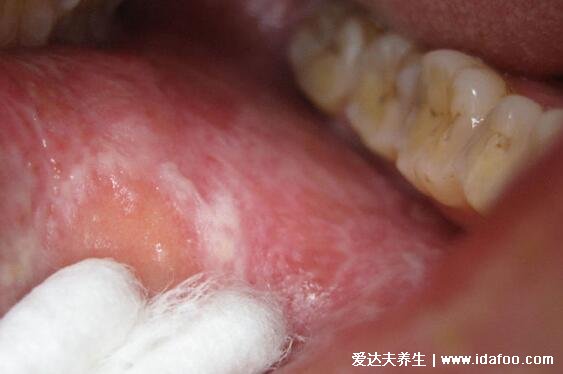 扁平苔藓图片症状，口腔长白斑/皮肤上有紫红色扁平丘疹