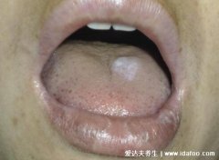 扁平苔藓癣长到嘴唇上(口腔丘疹扁平苔藓