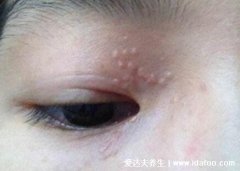 上颚有一个凸起的小疙瘩不痛不痒(皮肤下