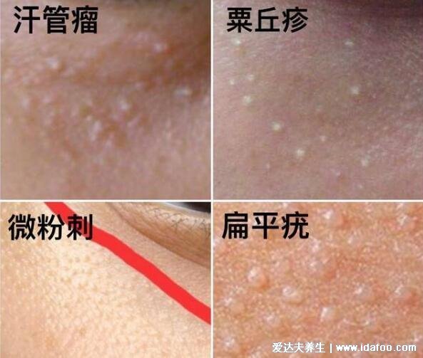 眼部扁平疣图片及去除方法，不痛不痒有传染性的粉色疙瘩