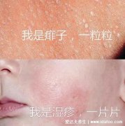 痱子和湿疹怎么区分(湿疹和痱子的区别