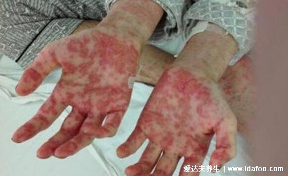 白血病初期针孔小红点图片，大片紫红色瘀斑不高出皮肤不褪色