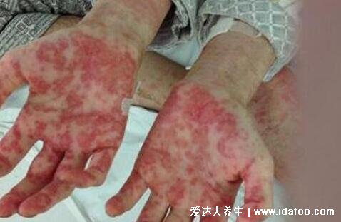 白血病初期针孔小红点图片，变瘀斑不痒按压不褪色(自我检查法)