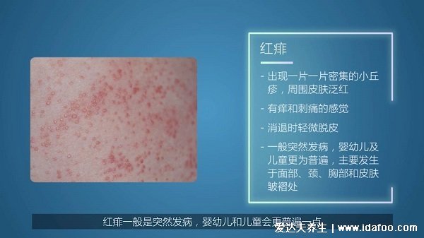 一张图教你区别湿疹和痱子，从部位/症状/时间区分(湿疹时间长)