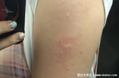 打完第三针疫苗胳膊疼(打完新冠第三针疫