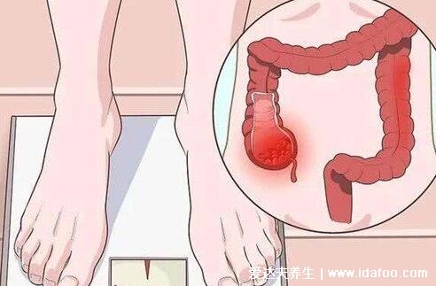 肠炎与肠癌最明显的区别，注意肠炎肠癌症状(肠癌拉出来的大便图)