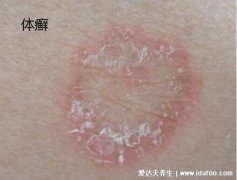 体癣病与湿疹的区别(欧布奥特曼100种卡片
