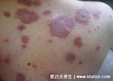 白血病初期针孔小红点图片，大片紫红色瘀斑不高出皮肤不褪色