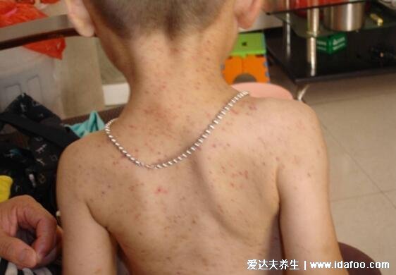 白血病初期针孔小红点图片，大片紫红色瘀斑不高出皮肤不褪色