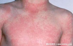 风疹和麻疹主要鉴别点(麻疹水痘手足口病