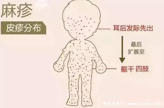 初期麻疹图片和症状图片，先发热再出疹从发际开始(按压褪色)
