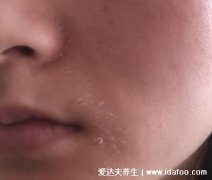 头部脂溢性皮炎结痂(脂溢性皮炎 大块头