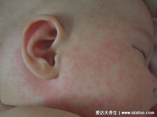 初期麻疹图片和症状图片，先发热再出疹从发际开始(按压褪色)