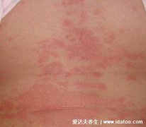麻疹一般是什么原因(麻疹发疹前期症状有
