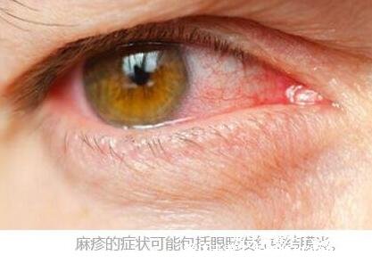 初期麻疹图片和症状图片，先发热再出疹从发际开始(按压褪色)