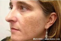 老年人血管斑块消除最快的方法(45岁血管