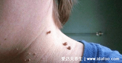 感染HPV病毒 就会恶变成宫颈癌吗？造成宫颈癌的真正真相究竟是什么？