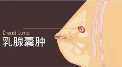 乳腺囊肿会变成乳腺癌吗怎么治疗(乳腺囊