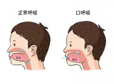 别让口呼吸毁了孩子的颜值