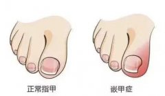 指甲脱落重新长过程需要注意什么(脚指甲