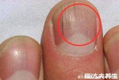指甲有竖条纹是身体的信号图？指甲竖条