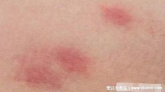 毒血热引起的皮肤病图片，引起各种皮疹/毛囊炎/红斑狼疮/银屑病。