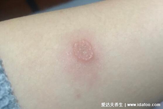 圆癣体癣钱币癣初期图片和症状，圆形红斑边缘有一圈脱屑瘙痒