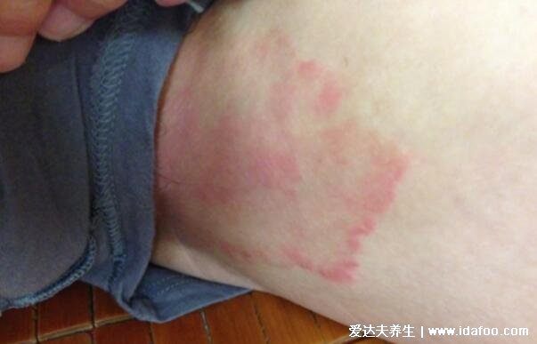 圆癣体癣钱币癣初期图片和症状，圆形红斑边缘有一圈脱屑瘙痒