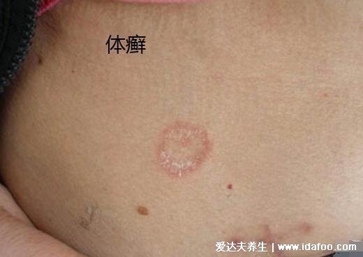 圆癣体癣钱币癣初期图片和症状，圆形红斑边缘有一圈脱屑瘙痒