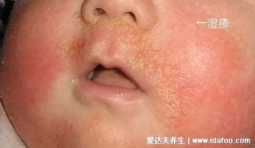 脸部过敏性皮炎图片和症状，丘疹红斑瘙痒避免抓痒(3种类型图)