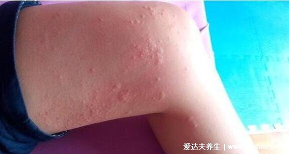 初期荨麻疹图片和症状，身上起红疙瘩很痒的图片(4种类型)